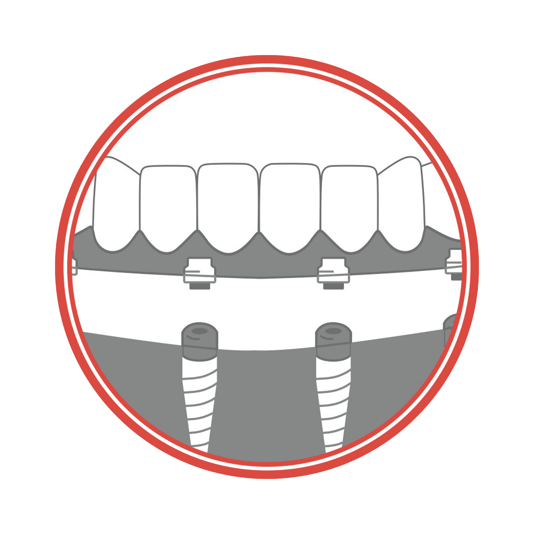 Maîtriser les prothèses fixées,  hybrides et amovibles sur implants chez l’édenté complet